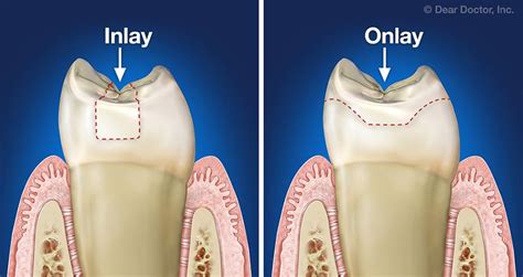 Inlays & Onlays | Northwest Dental | Glyndon Maryland