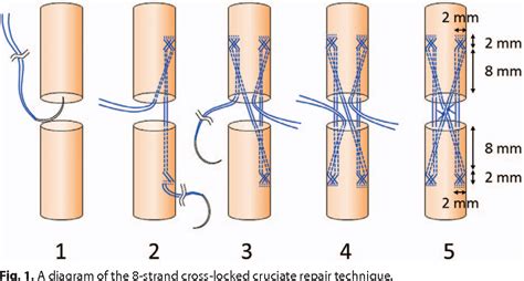 [PDF] Eight-strand Cross-locked Cruciate Flexor Tendon Repair Using Double-stranded Suture: A ...