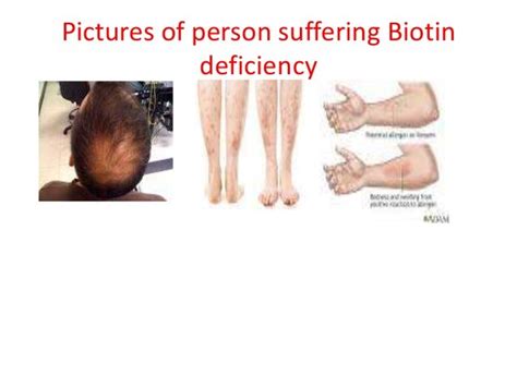 DAEVIA'S HFLE BIOTIN DEFFICIENCY