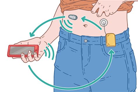 How does an “artificial pancreas” work? | Marie Ducom - Science Illustrator