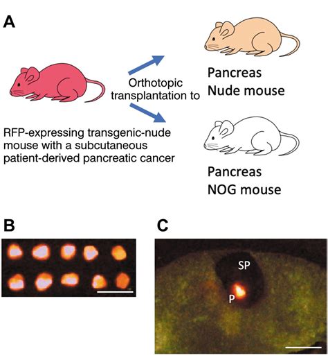 High Incidence of Lymph-node Metastasis in a Pancreatic-cancer Patient-derived Orthotopic ...