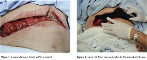 Colocutaneous Fistula Management in a Dehisced Wound: A Case Study