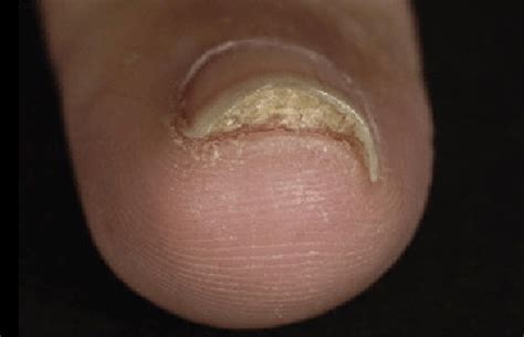 The Many Reasons Your Toenail Skin Might Be Peeling | Heidi Salon