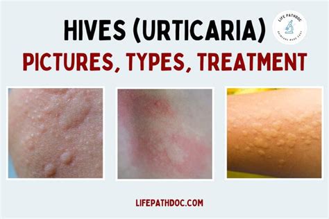 Hives (Urticaria) Pictures, Types, Causes & Treatment