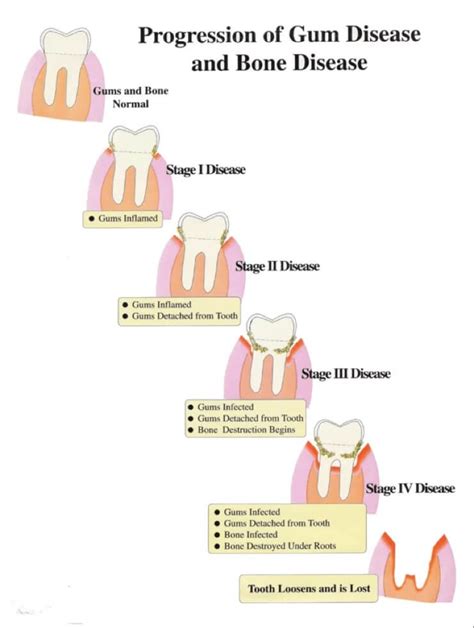 Stages of a loose tooth | News | Dentagama