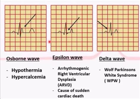 Abnormal waves EKG | Paramedic school, Nurse, Fire emt