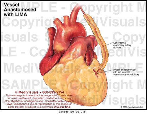 Vessel Anastomosed with LIMA Medical Exhibit Medivisuals