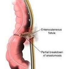 Intestinal Fistula