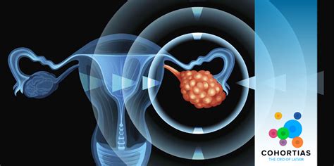 Clinical Trial – Treatment for Ovarian Cancer.