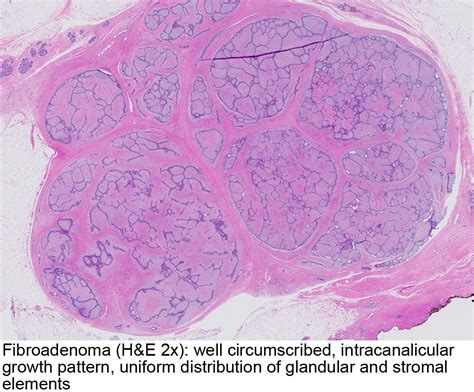 Pathology Outlines - Fibroadenoma