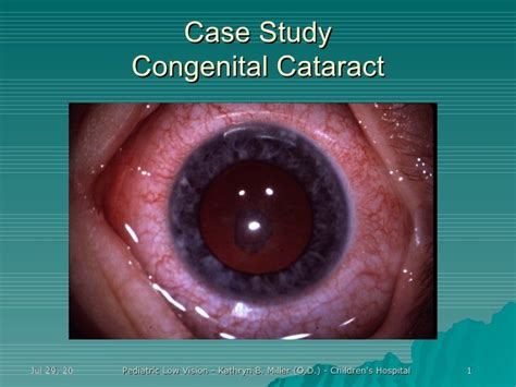 Case Study: Congenital Cataracts