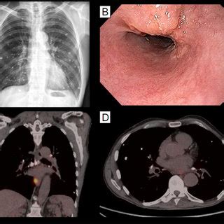 Imaging studies and upper endoscopy on diagnosis. A: Chest x-ray... | Download Scientific Diagram