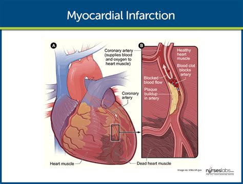 Myocardial infarction is the death of the muscle fibers of the heart.