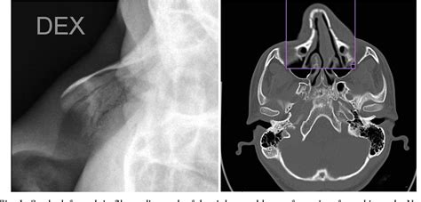 Figure 1 from Nasal Bone Fractures In Children And Adolescents. Patient ...