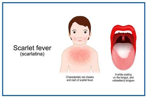 Scarlet fever symptoms - Costamedic