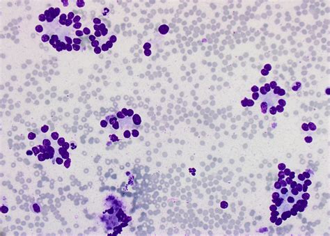 Follicular neoplasm of the thyroid gland | MyPathologyReport.ca