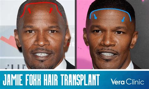 Did Jamie Foxx Hair Transplant