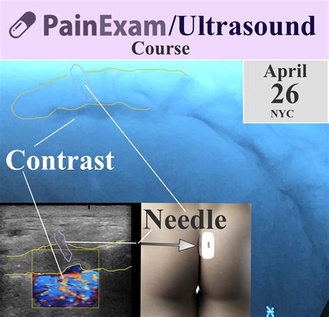 The PainExam podcast: The Ultrasound Guided Ganglion Impar Block