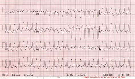 VT versus SVT • LITFL Medical Blog • ECG Library Basics