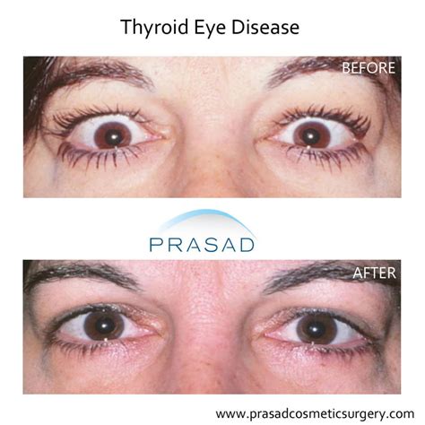 Hyperthyroidism Eyes Before And After