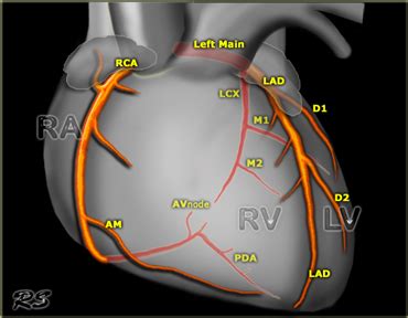 The Radiology Assistant : Coronary anatomy and anomalies