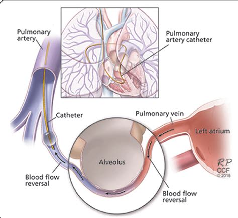 Illustration showing the origin of the pulmonary artery wedge blood... | Download Scientific Diagram