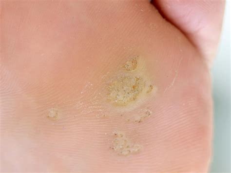 Plantar callus: Symptoms, causes, and how to remove them