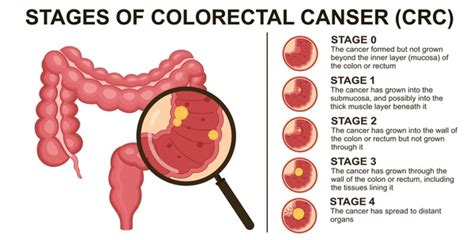 Colon Cancer Stool Shape