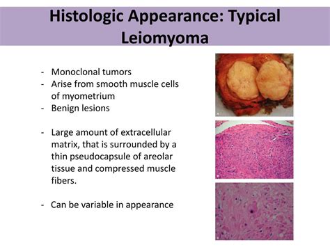 PPT - Uterine Leiomyoma PowerPoint Presentation, free download - ID:2372404