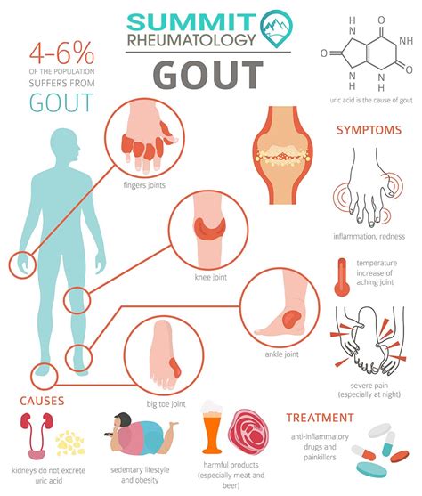 Gout Treatment Guide | Summit Rheumatology