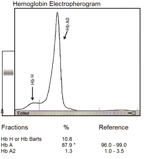 Electropherogram of patient's blood specimen. | Download Scientific Diagram