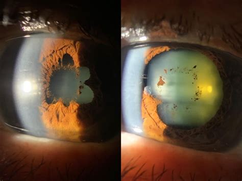 Broke most of the synechiae : optometry