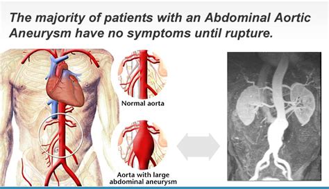 Abdominal Aortic Aneurysms | Prevention