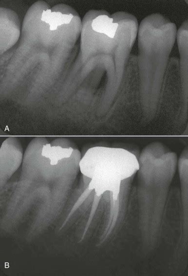 Pulpal anatomy and access preparations | Pocket Dentistry