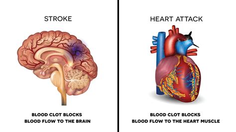 STROKE ATTACK : A stroke may be caused by a blocked artery (ischemic stroke) or the leaking or ...