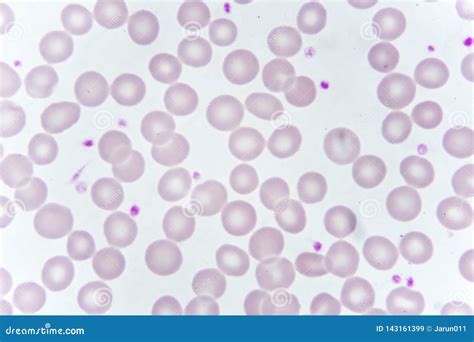 Blood Smear Anemia Patient Show NRBC Medical Science Royalty-Free Stock Image | CartoonDealer ...