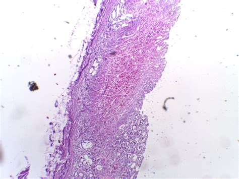 Peptic Ulceration Histology