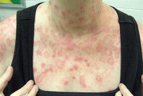 Tinea corporis causes, symptoms, diagnosis & treatment