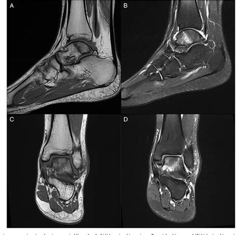 Talus Fracture Mri