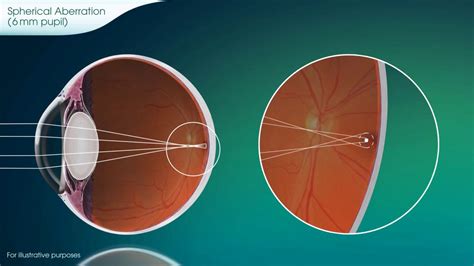 Spherical Aberration Explained - PureVision2 - YouTube