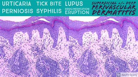 Urticaria, Tick Bite, Syphilis, Lupus, Perniosis, etc: Perivascular Dermatitis Pattern Dermpath ...