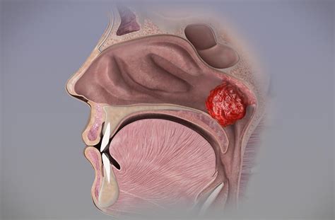 Adenoidectomia – Centro Otorrino BH