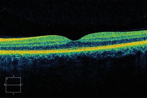 Optical Coherence Tomography in Age-related Macular Degeneration | www.amdbook.org