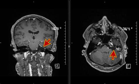 Cureus | Curing Benign Paroxysmal Positional Vertigo in Patients With Brain Tumor: Case Series ...