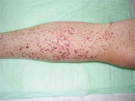 Vasculitis - DocCheck