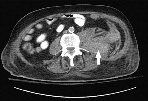 Spontaneous Retroperitoneal Hematoma in the Setting of Myasthenic Crisis | Cureus