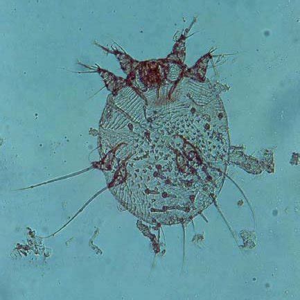 (PDF) A Case Report of Sarcoptes scabiei Infection in Ahwaz, Iran