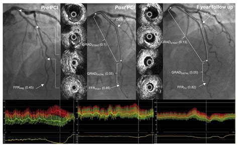 Diagnostics | Free Full-Text | Intravascular Ultrasound vs. Fractional Flow Reserve for ...