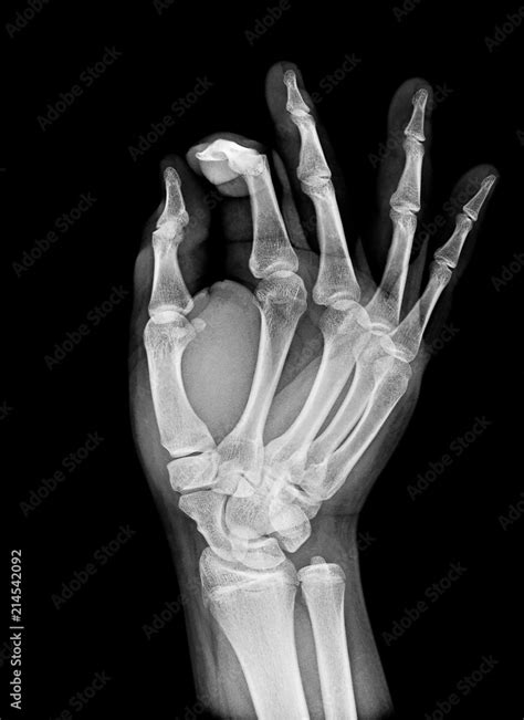 X-ray image of normal Hand , xray medical background. Stock Photo | Adobe Stock