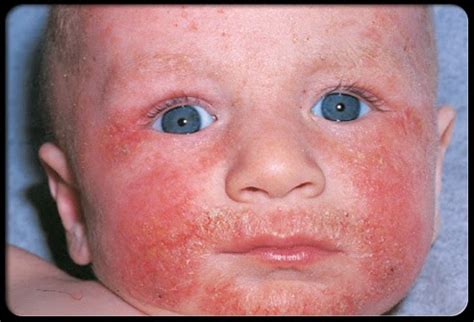 Eczema Specialist: Where to seek treatment for baby (pediatric) eczema in Singapore?